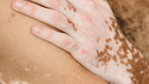 Vad du inte visste om vitiligo